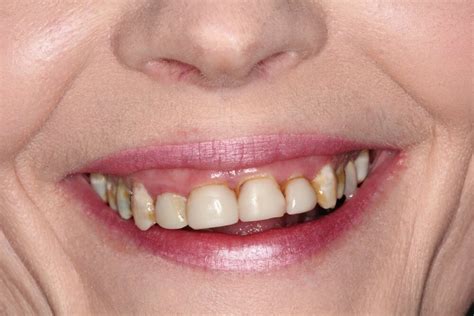 Laser Gum Treatment Before And After Gallery Starimage Dentistry