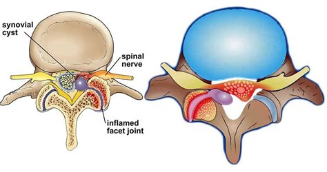 Learn About Spinal Synovial Cysts Causes Symptoms And Treatment