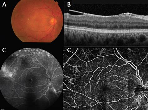 Panoramic Imaging With OCTA Retina Today