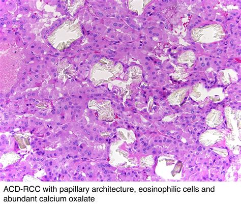 Pathology Outlines Acquired Cystic Disease Associated