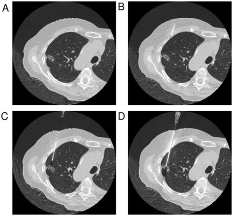 Lung Nodule Biopsy Procedure