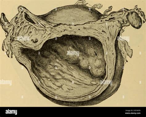 Cervical bleeding hi-res stock photography and images - Alamy