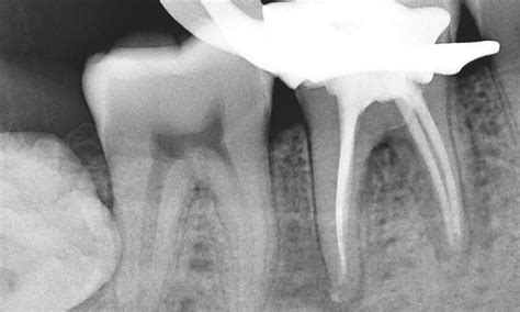 Root Canal - Lower Molar Before & After Photos | Garran ACT