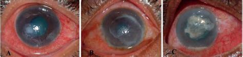 Keratitis Causes Symptoms Diagnosis Prevention Treatment