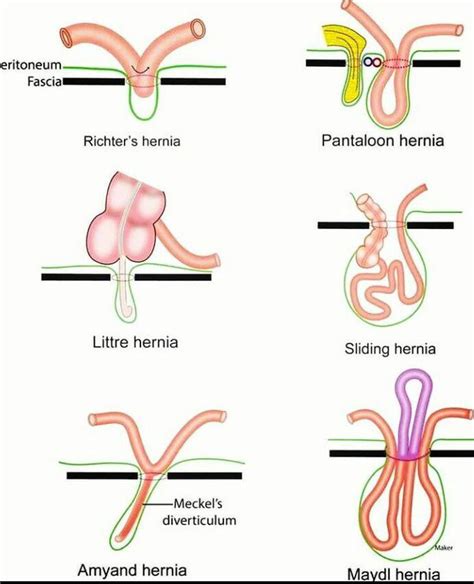 Different Types Of Hernia Medizzy