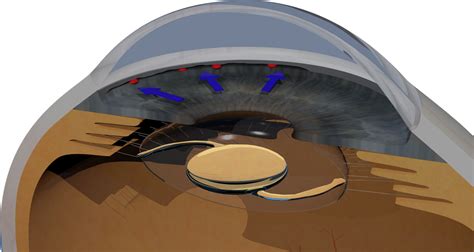 Cataract IOL Surgery Side Effects - Merrillville, Hobart, IN