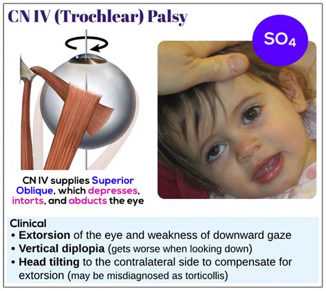 CN IV (trochlear) palsy - Medicine Keys for MRCPs