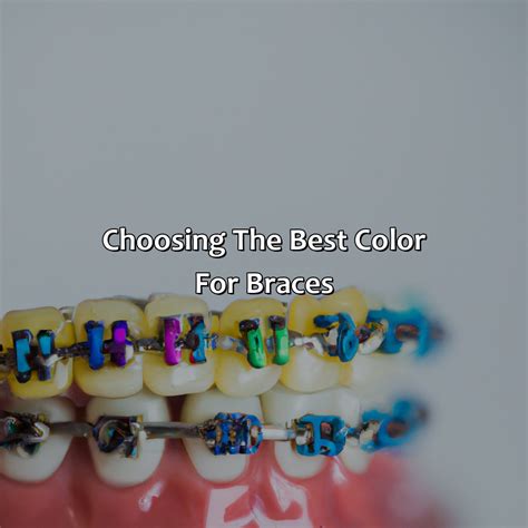 What Color Is Best For Braces