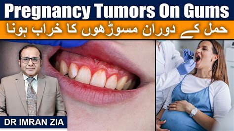 Pregnancy Tumors حمل کے دوران مسوڑھوں کا خراب ہونا Dr Imran Zia