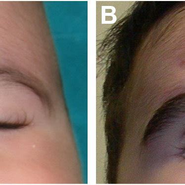 A Preoperative And B Postoperative Result Of Frontalis Sling