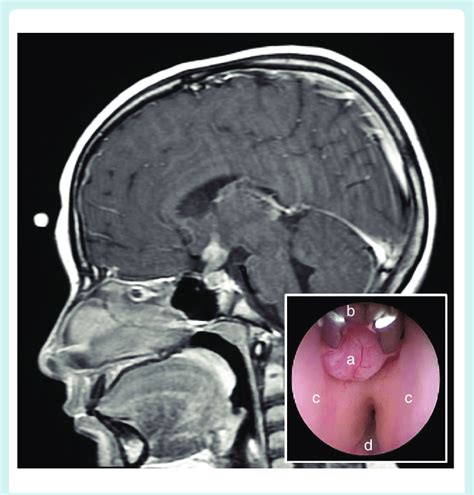 Sagittal Post Contrast Mri Of The Brain Demonstrating A Hypothalamic Download Scientific