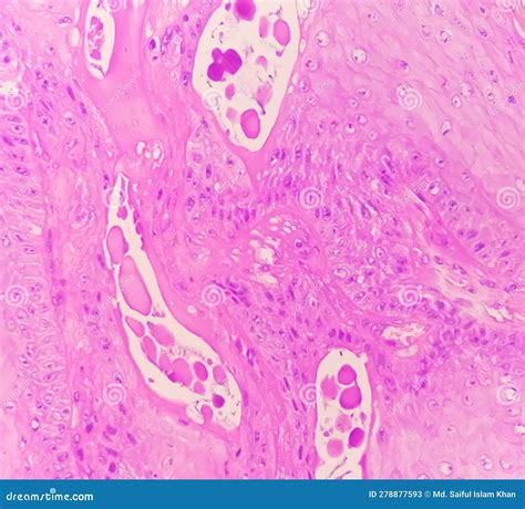 Photomicrography Of Squamous Hyperplasia Stock Image Image Of Bucco