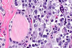 C-cell hyperplasia - Libre Pathology