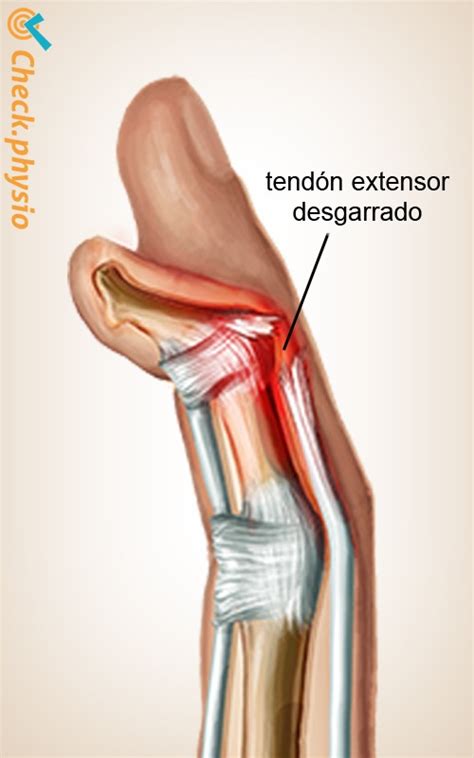 Dedo En Martillo Physio Check