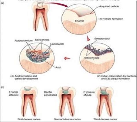 3. Stages in plaque development and cariogenesis. The macroscopic and ...