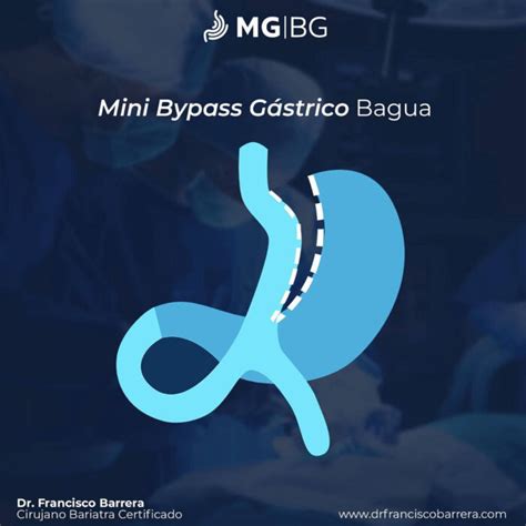 Mini Bypass Gástrico Monterrey Bariatras En Monterrey