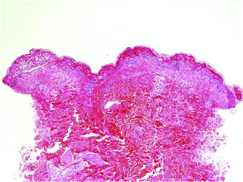 Low Power Histologic Examination Of A Punch Biopsy Of The Skin