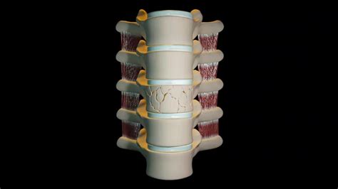 Vertebroplasty Bristol Spine Intervention