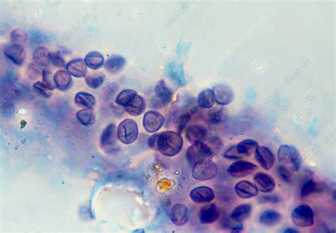 Lm Of Pneumocystis Carinii Cysts From Aids Lung Stock Image M1120242 Science Photo Library