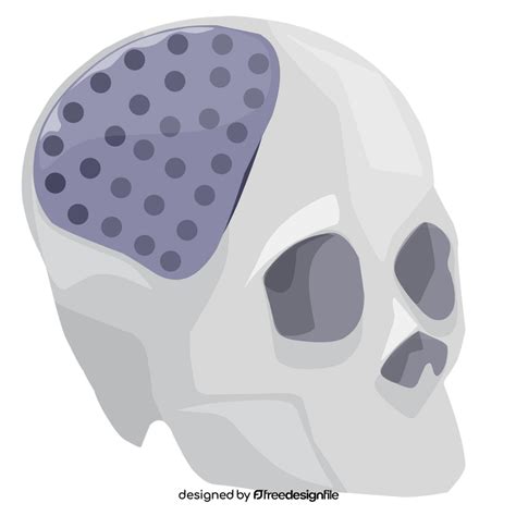 Skull implant 3d printing clipart vector free download