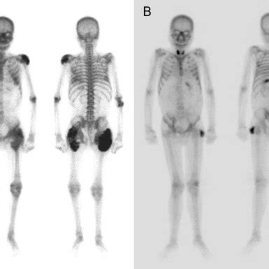 Pdf Resolution Of Uremic Tumoral Calcinosis In A Patient On