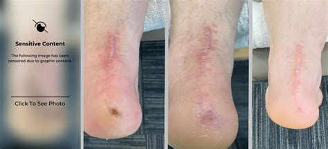 Amazing Results Post Achilles Tendon Surgery - Astym