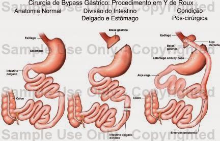 Vida de Uma Linda Borboleta: Minha cirurgia: Bypass Gástrico em Y de ...