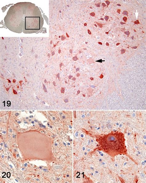 Pantothenic Acid Responsive Degenerative Myelopathy L Spinal Cord