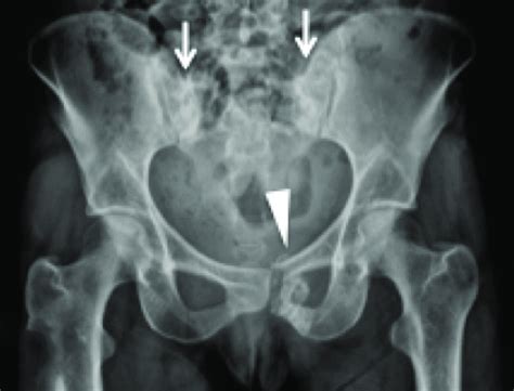 Anterior Posterior Radiographs Of Pelvis Showing Insufficiency Download Scientific Diagram