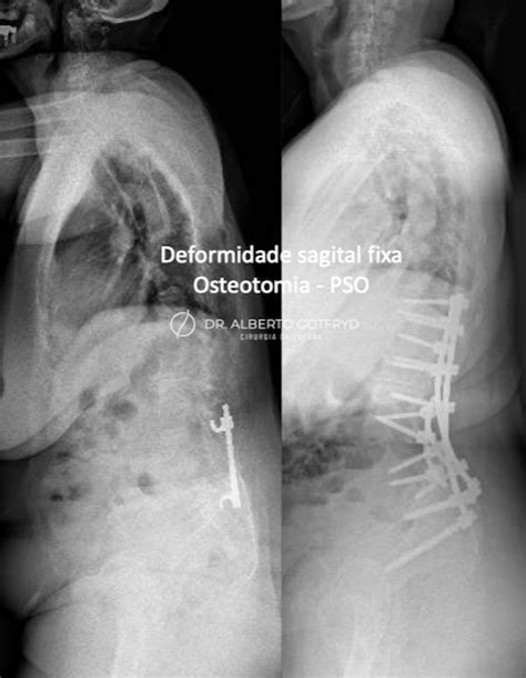 Deformidades Da Coluna Do Adulto Dr Alberto Gotfryd
