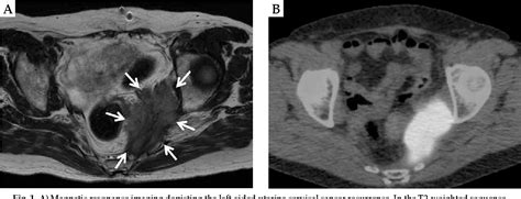 Figure 1 From High Dose Rate Interstitial Brachytherapy With Hypoxic Radiosensitizer Kortuc Ii