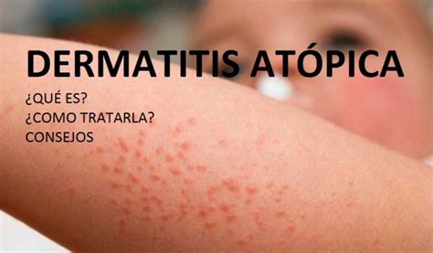 Dermatitis Atópica La Segunda Enfermedad Más Diagnosticada Del Mundo Río Grande Plus