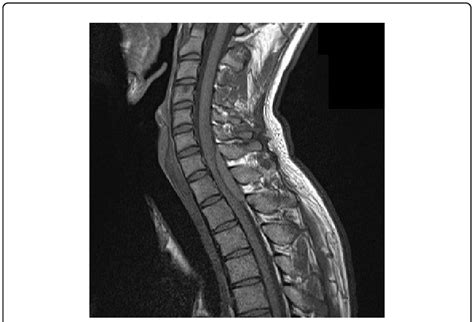 T1 Weighted Saggital Magnetic Resonance Image Isointense Mass