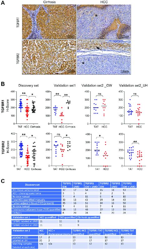 IHC Analysis Of TGFBR1 And TGFBR2 In Liver Tissue From Cirrhotic