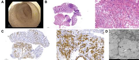 Unusual White Yellowish Dots In The Colon Reveal A Rare Metabolic Disease Gastroenterology