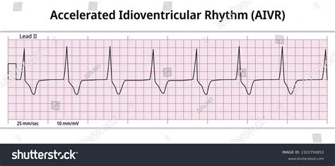 ECG Accelerated Idioventricular Rhythm - 8 - Royalty Free Stock Vector ...