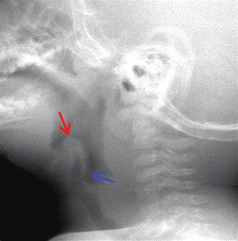 Croup Anteroposterior Radiograph Showing The Normal Shouldering Green Download Scientific