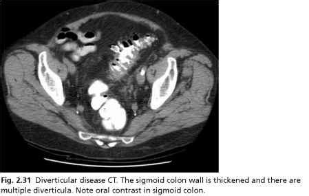 Diverticular abscess - Anaesthesia - European Medical