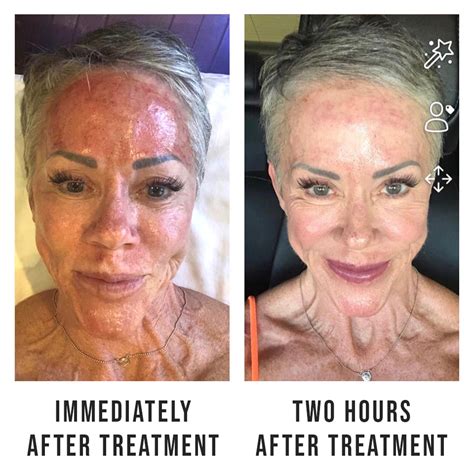 Exo Rt Microneedling In Tucson Vg Beauty Lounge