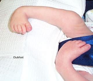 CTEV (Congenital Talipes Equinovarus) or Clubfoot | Treatment Zone