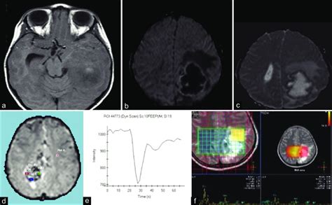 Supratentorial Ependymoma Intraparenchymal Form A Axial T1 Weighted Download Scientific