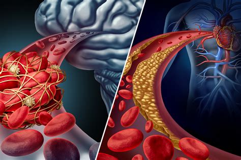 Stroke vs. Heart Attack: How to Tell the Difference | U.S News