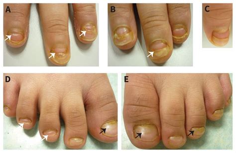 Onychomadesis Secondary To Hand Foot And Mouth Disease