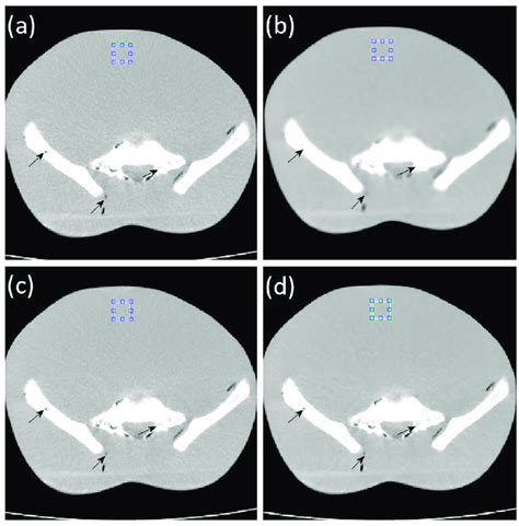 Image Of Anthropomorphic Phantom In The Pelvic Region Scanned At A Dose Download Scientific