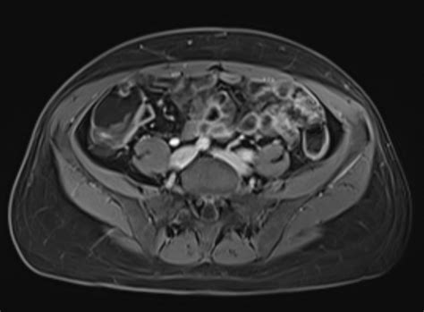 Magnetresonanztomografie Mrt Radiologie Filstal