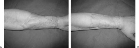 Sex Reassignment Surgery In The Female To Male Transsexual PMC