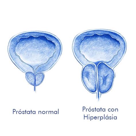 Hiperplasia Benigna De Pr Stata Hbp Hc Marbella Hc Marbella