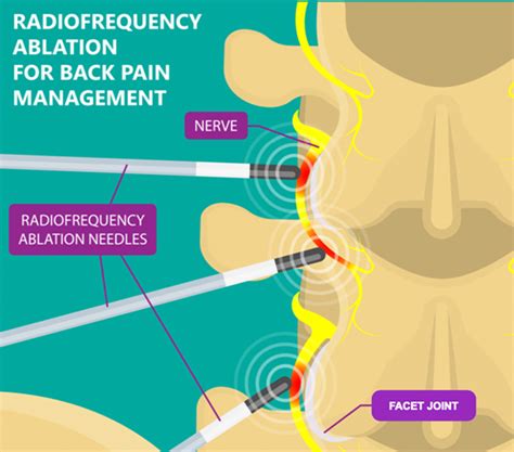 RADIOFREQUENCY ABLATION RFA Rhizotomy The Orthopedic Pain