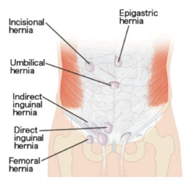 About Hernias