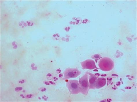 Metaplastic squamous cells with eosinophilic intracytoplasmic inclusion... | Download Scientific ...